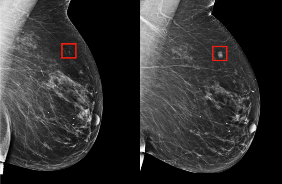 Tumore Al Colon retto Diagnosi Pi Precisa Con L intelligenza 