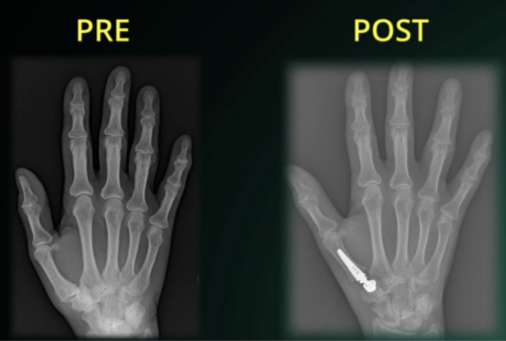 radiografia mano articolazione pollice protesi