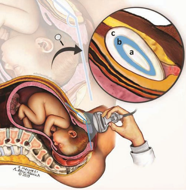 Illustrazione medica del posizionamento della sonda transperineale sul perineo materno per la misurazione dell'angolo di progressione (AoP), con dettaglio anatomico della testa fetale in sezione trasversale