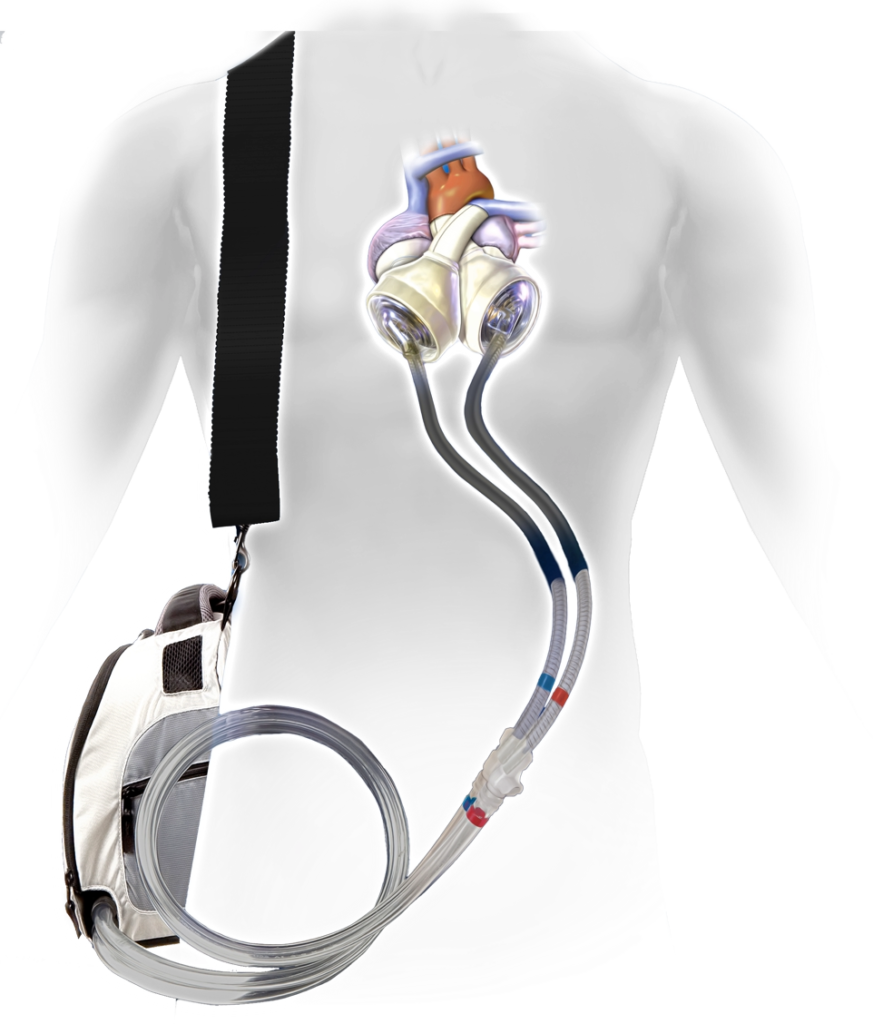 Illustrazione del sistema SynCardia impiantato nel torace, con cannule che collegano i ventricoli artificiali al driver portatile Freedom indossato a tracolla