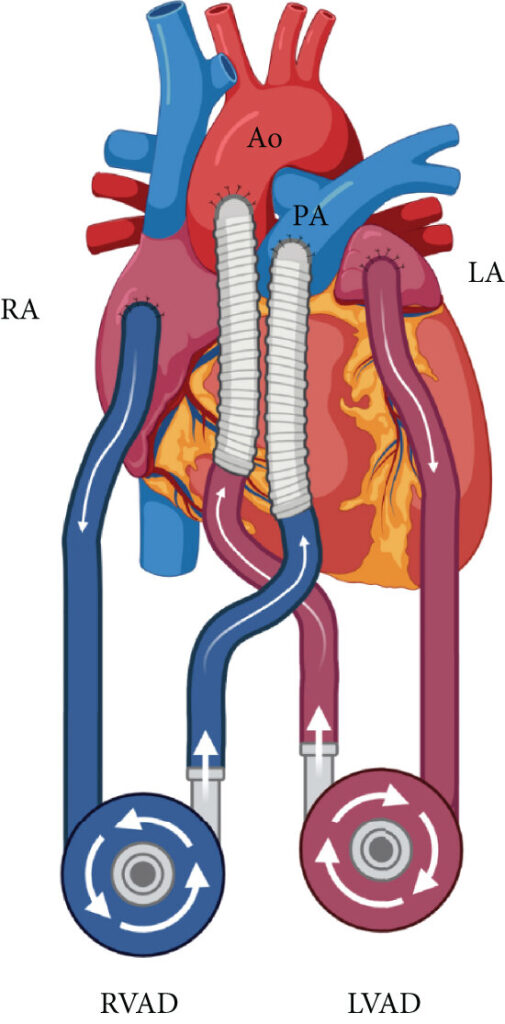 ventricular assistant device