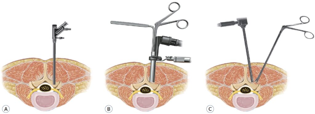 Sezioni anatomiche della colonna che mostrano la traiettoria degli strumenti verso il disco nelle tre tecniche