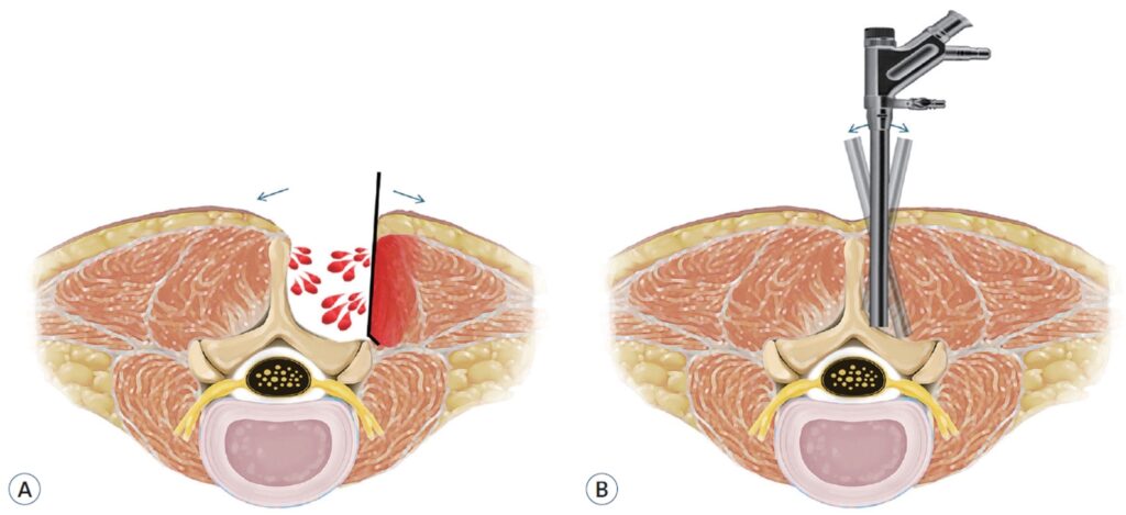 Sezione trasversale della colonna: (A) chirurgia aperta con muscoli divaricati; (B) endoscopia con sottile cannula