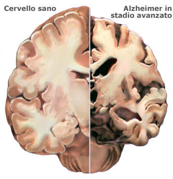 Confronto cervello sano cervello morbo stato avanzato Alzehimer