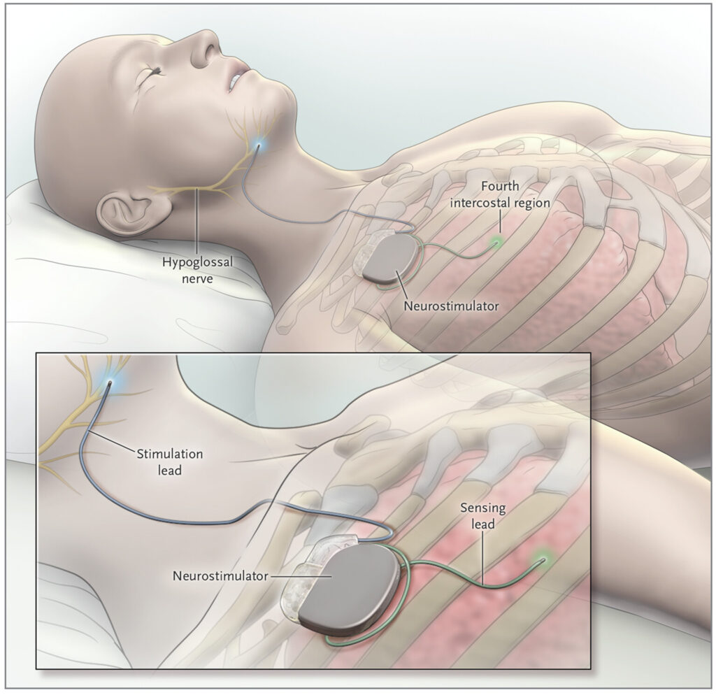 Schema del sistema Inspire: neurostimolatore nel torace collegato al nervo ipoglosso e a un sensore intercostale