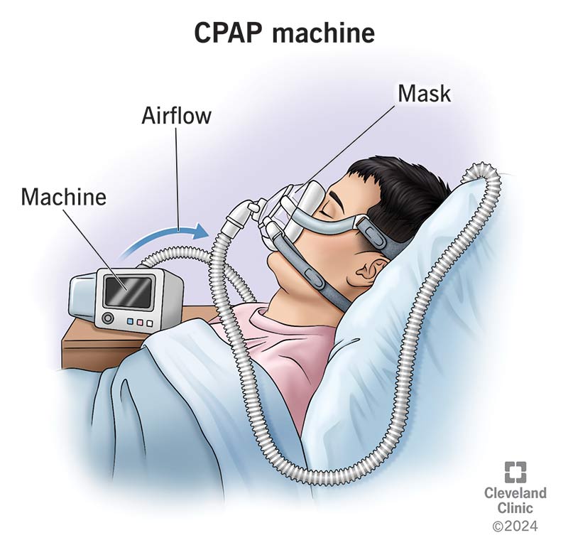 Schema di un dispositivo CPAP: una macchina collegata tramite un tubo a una maschera indossata da una persona a letto