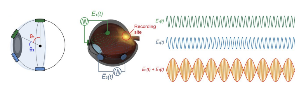 Schema degli elettrodi posizionati sull'occhio a θ1=60° e θ2=30° e dei due segnali ad alta frequenza che, sommandosi, generano un inviluppo a bassa frequenza nella zona retinica