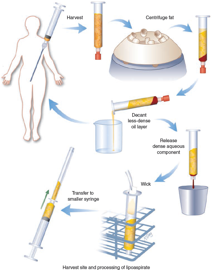 Diagramma della procedura di Coleman: le sei fasi del lipofilling — prelievo, centrifugazione, decantazione dello strato oleoso, rilascio della componente acquosa, stoppaggio e trasferimento in siringa più piccola — mostrano ogni apertura del circuito tra contenitori diversi